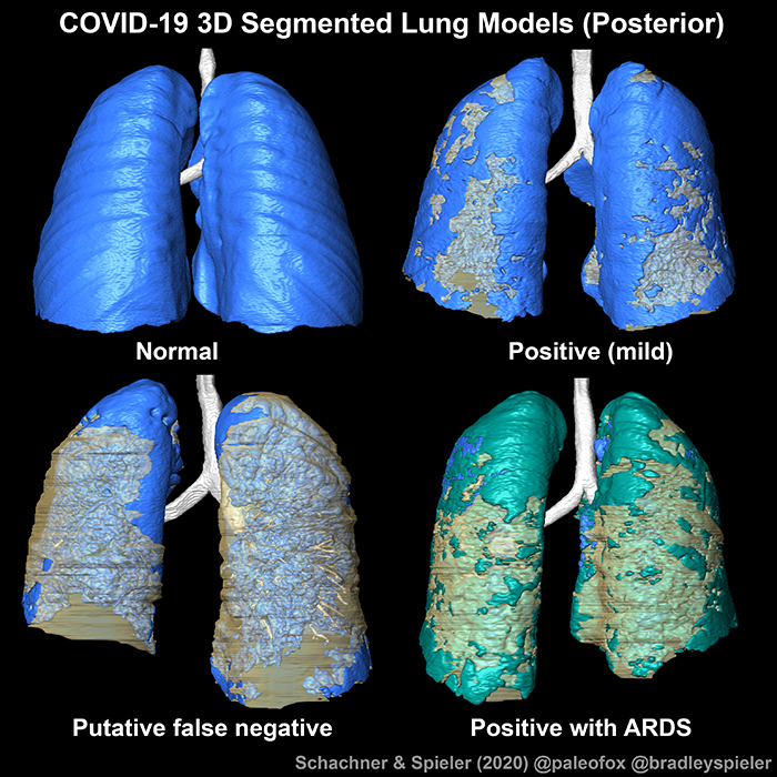 LSU Health COVID 3D models